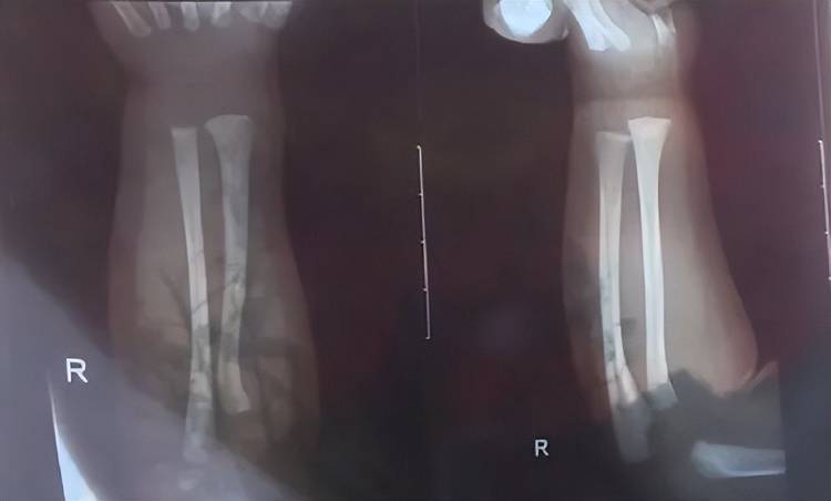 广西一男婴在月子中心被照料20天：身上2处骨折，育婴室监控无法查看