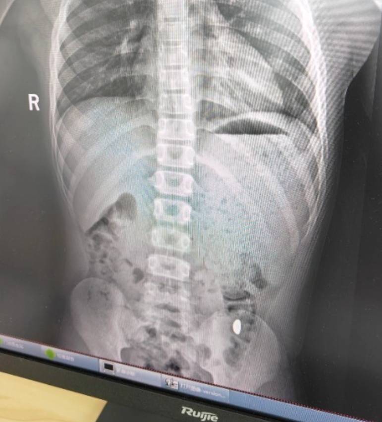 “熊孩子”误吞10克重金豆，妈妈：天天叮嘱他不要在外面拉屎